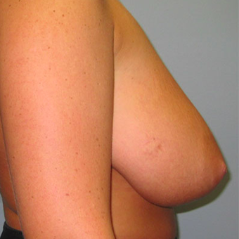 35-44 year old woman treated with Breast Augmentation before 3467364