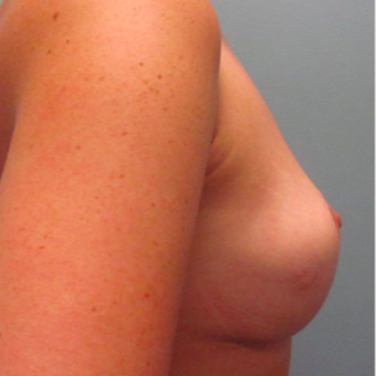 35-44 year old woman treated with Breast Augmentation after 3467364