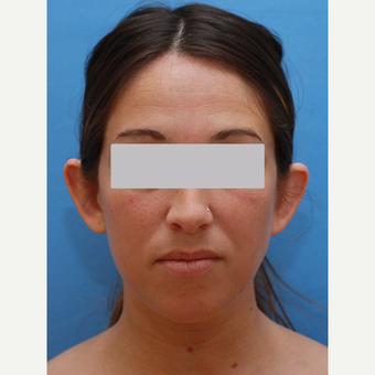 25-34 year old woman treated with Otoplasty for her Prominent Ears before 3345584