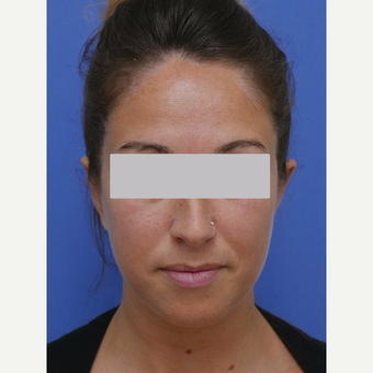 25-34 year old woman treated with Otoplasty for her Prominent Ears after 3345584