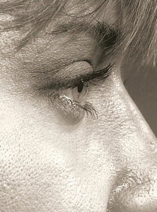 29 Year Old Female Who Underwent Upper and Lower Blepharoplasty after 1450386