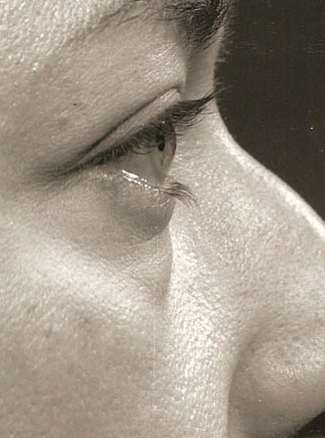 29 Year Old Female Who Underwent Upper and Lower Blepharoplasty before 1450386