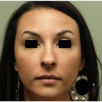 25-34 year old woman treated with Rhinoplasty before 3567018