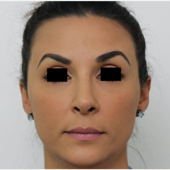 25-34 year old woman treated with Rhinoplasty after 3567018