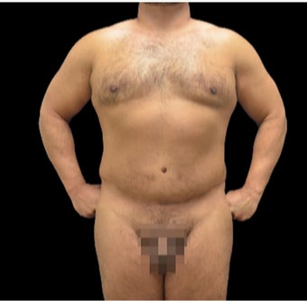 35-44 year old man treated with VASER Shape before 3220637