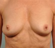 58 year old female breast augmentation before 1171958