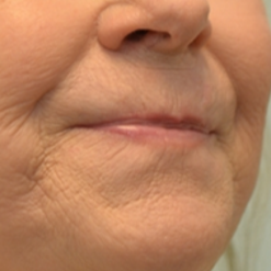 1 syringe of Restylane and 1 syringe of Juvederm to correct vertical lip lines and increase fullness before 2272687