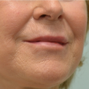 1 syringe of Restylane and 1 syringe of Juvederm to correct vertical lip lines and increase fullness after 2272687