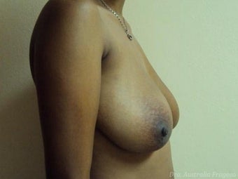 31 year old female treated for brest lift 968552