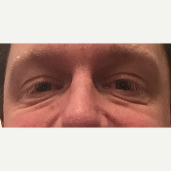 44 year old man treated with Eyelid Surgery before 3749243