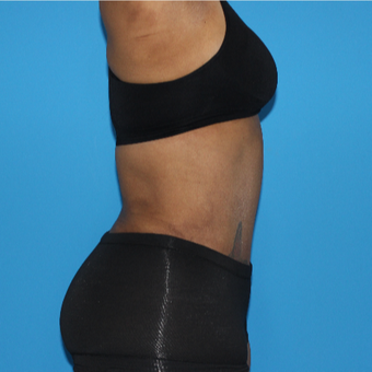 45-54 year old woman treated with Tummy Tuck after 3332959