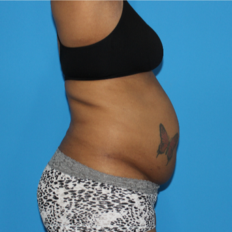 45-54 year old woman treated with Tummy Tuck before 3332959