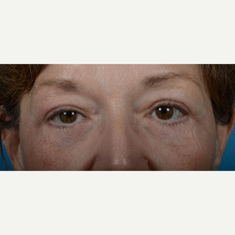 Woman treated with Upper Eyelid Surgery, Lower Eyelid Surgery, and Eye Bags Treatment after 2681854