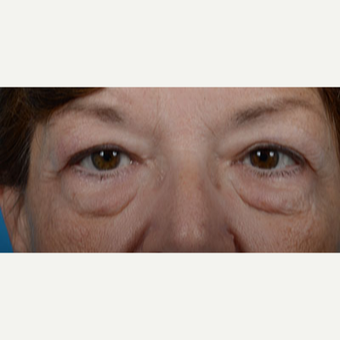 Woman treated with Upper Eyelid Surgery, Lower Eyelid Surgery, and Eye Bags Treatment before 2681854