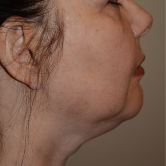 55-64 year old woman treated with Chin Liposuction before 3294085