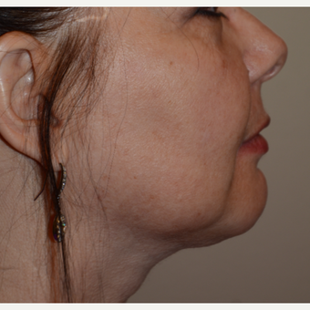 55-64 year old woman treated with Chin Liposuction after 3294085