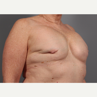 65-74 year old woman treated with Breast Reconstruction Revision before 3371048