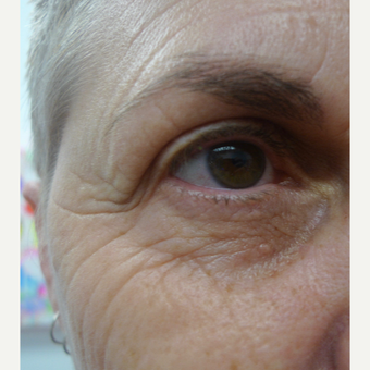 Eye rejuvenation with CO2 laser before 3133562