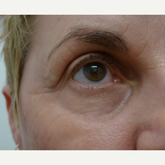 Eye rejuvenation with CO2 laser after 3133562