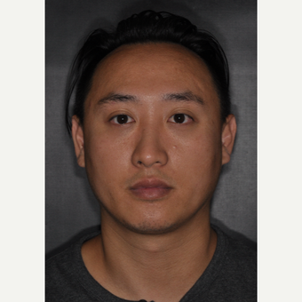 35-44 year old man treated with Nose Surgery 8 months post-op after 3500065