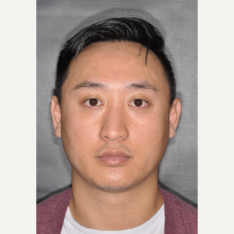35-44 year old man treated with Nose Surgery 8 months post-op before 3500065
