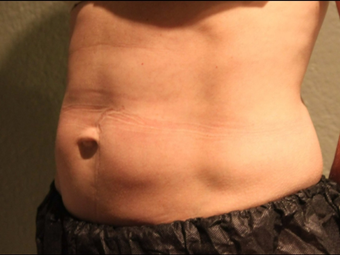 Late 30s Mom Opts for CoolSclupting First – Before Considering Surgery 1383438