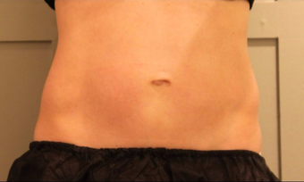 Late 30s Mom Opts for CoolSclupting First – Before Considering Surgery after 1383438