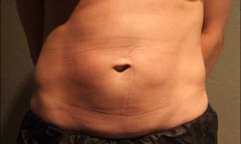Late 30s Mom Opts for CoolSclupting First – Before Considering Surgery before 1383438