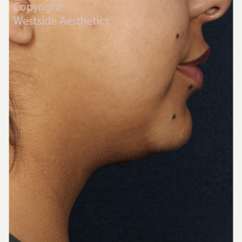 Kybella Double Chin Treatment after 2972758