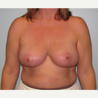 45-54 year old woman treated with Breast Reduction after 3851592