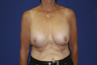 58 year old patient seeking to remove older breast implants after 1249622