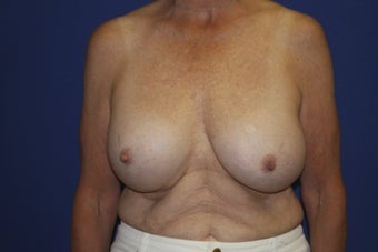 58 year old patient seeking to remove older breast implants before 1249622