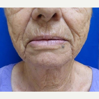 65-74 year old woman treated with Ultherapy after 3711577