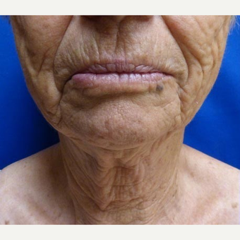 65-74 year old woman treated with Ultherapy before 3711577