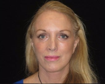55-64 year old woman treated with Facelift, lower blepharoplasty after 2509126