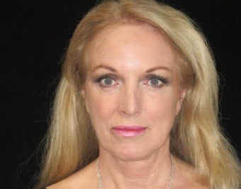 55-64 year old woman treated with Facelift, lower blepharoplasty before 2509126