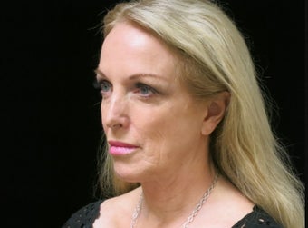 55-64 year old woman treated with Facelift, lower blepharoplasty 2509126