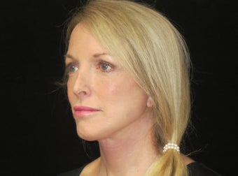 55-64 year old woman treated with Facelift, lower blepharoplasty 2509126