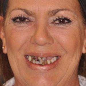 Teeth replaced with All-on-4 Dental Implants before 3696592
