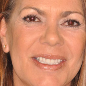 Teeth replaced with All-on-4 Dental Implants after 3696592