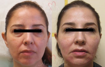 35-44 year old woman treated with Bellafill before 3670674