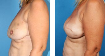 42 Year Old Woman, Cassileth One-Stage Breast Reconstruction after 1039918