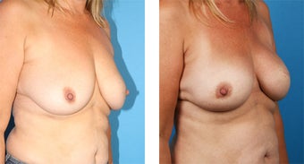 42 Year Old Woman, Cassileth One-Stage Breast Reconstruction 1039918