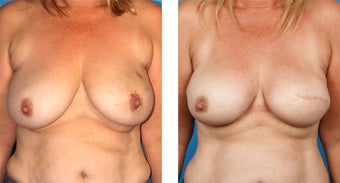 42 Year Old Woman, Cassileth One-Stage Breast Reconstruction before 1039918
