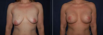 Breast lift with implants before 1380996