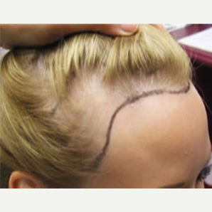 25-34 year old woman treated with Hair Transplant before 3714879