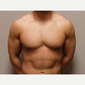 25-34 year old man treated with Male Breast Reduction after 3454630