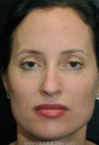 Sculptra before 227154