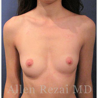 Bilateral Breast Augmentation & Correction of Asymmetry in level of Breast Fold - Pre- & 8 Month Post-op before 3473929