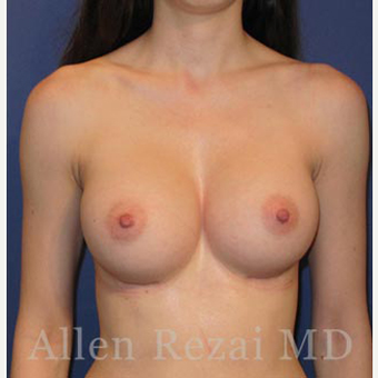 Bilateral Breast Augmentation & Correction of Asymmetry in level of Breast Fold - Pre- & 8 Month Post-op after 3473929